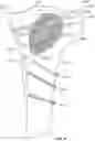 Fig. 49 - BONE FRACTURE REPAIR APPARATUS AND METHODS