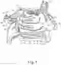 Fig. 02 - Apparatus and method for performing vidian neurectomy procedure