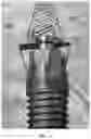 Fig. 02 - IMPLANT ATTACHMENT SYSTEM