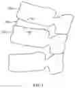 Fig. 02 - Expandable spinal implant apparatus and method of use