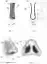 Fig. 02 - DIAGNOSTIC METHOD AND NOSE CLIP FOR SELECTING TREATMENT FOR LATERAL WALL WEAKNESS/NASAL VALVE COLLAPSE IN A NOSE