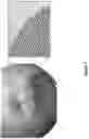 Fig. 08 - Flexible microfluidic meshwork for glaucoma surgery