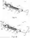 Fig. 02 - Dilation catheter with removable bulb tip