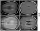 Fig. 04 - Methods and materials for identifying and treating autoimmune GFAP astrocytopathy