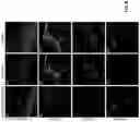 Fig. 09 - Methods and materials for identifying and treating autoimmune GFAP astrocytopathy