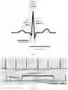 Fig. 02 - Detecting abnormalities in ECG signals