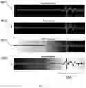Fig. 06 - Detecting abnormalities in ECG signals