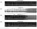 Fig. 07 - Detecting abnormalities in ECG signals