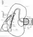 Fig. 01 - Hearing device comprising adaptive sound source frequency lowering