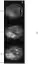 Fig. 06 - Topological evolution of tumor imagery