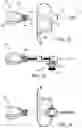 Fig. 09 - Compression and tension instruments and methods of use to reinforce ligaments