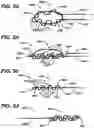 Fig. 06 - Methods and devices for repairing meniscal tissue