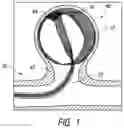 Fig. 02 - Embolic medical devices