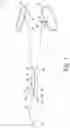 Fig. 02 - Orthopaedic surgical saw assembly for removing an implanted glenoid component and method of using the same