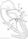 Fig. 01 - Valve prosthesis having a radially expandable sleeve integrated thereon for delivery and prevention of paravalvular leakage