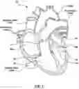 Fig. 02 - Valve prosthesis having a radially expandable sleeve integrated thereon for delivery and prevention of paravalvular leakage