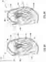 Fig. 03 - Valve prosthesis having a radially expandable sleeve integrated thereon for delivery and prevention of paravalvular leakage