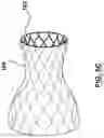 Fig. 08 - Valve prosthesis having a radially expandable sleeve integrated thereon for delivery and prevention of paravalvular leakage