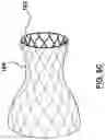 Fig. 10 - Valve prosthesis having a radially expandable sleeve integrated thereon for delivery and prevention of paravalvular leakage