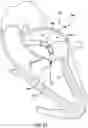 Fig. 11 - Valve prosthesis having a radially expandable sleeve integrated thereon for delivery and prevention of paravalvular leakage