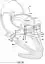 Fig. 12 - Valve prosthesis having a radially expandable sleeve integrated thereon for delivery and prevention of paravalvular leakage