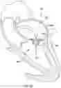 Fig. 13 - Valve prosthesis having a radially expandable sleeve integrated thereon for delivery and prevention of paravalvular leakage