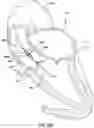 Fig. 18 - Valve prosthesis having a radially expandable sleeve integrated thereon for delivery and prevention of paravalvular leakage