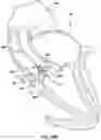 Fig. 19 - Valve prosthesis having a radially expandable sleeve integrated thereon for delivery and prevention of paravalvular leakage