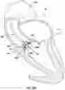 Fig. 20 - Valve prosthesis having a radially expandable sleeve integrated thereon for delivery and prevention of paravalvular leakage