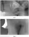 Fig. 09 - PHARMACEUTICAL COMPOSITION FOR TREATMENT OF INFLAMMATORY EAR DISEASES, METHOD FOR PRODUCING SAME AND METHOD FOR TREATMENT USING SAME COMPOSITION