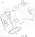 Fig. 02 - Catheter fixing band