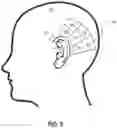 Fig. 06 - Neutralizing the effect of a medical device location