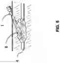 Fig. 06 - Failsafe percutaneous wound barrier
