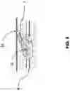 Fig. 07 - Failsafe percutaneous wound barrier