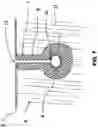 Fig. 08 - Failsafe percutaneous wound barrier