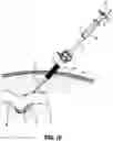 Fig. 09 - SURGICAL RETRACTORS