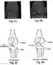 Fig. 06 - Methods and procedures for ligament repair