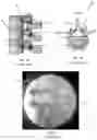 Fig. 02 - TWO DEGREE OF FREEDOM SYSTEM AND METHOD FOR SPINAL APPLICATIONS