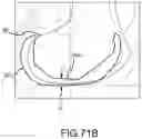 Fig. 197 - Systems and methods for surgical planning of arthroplasty procedures