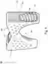 Fig. 04 - Interpedicular Spacer