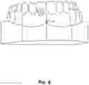 Fig. 09 - Direct 3D-printed orthodontic aligners with torque, rotation, and full control anchors