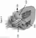 Fig. 07 - APPARATUS AND METHOD TO RESHAPE GEOMETRY OF DISEASED HEART VALVE