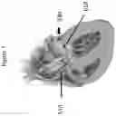 Fig. 08 - APPARATUS AND METHOD TO RESHAPE GEOMETRY OF DISEASED HEART VALVE