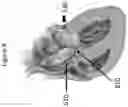 Fig. 09 - APPARATUS AND METHOD TO RESHAPE GEOMETRY OF DISEASED HEART VALVE