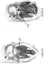 Fig. 02 - APPARATUS AND METHOD TO RESHAPE GEOMETRY OF DISEASED HEART VALVE