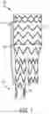 Fig. 02 - Steering wire attach for angulation