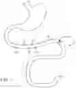 Fig. 02 - Swallowable capsule and method for stimulating incretin production within the intestinal tract