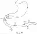 Fig. 06 - Swallowable capsule and method for stimulating incretin production within the intestinal tract