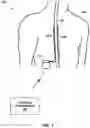 Fig. 02 - ECAP based control of electrical stimulation therapy