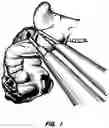 Fig. 02 - APPARATUS AND METHOD FOR ENDOSCOPIC COLECTOMY